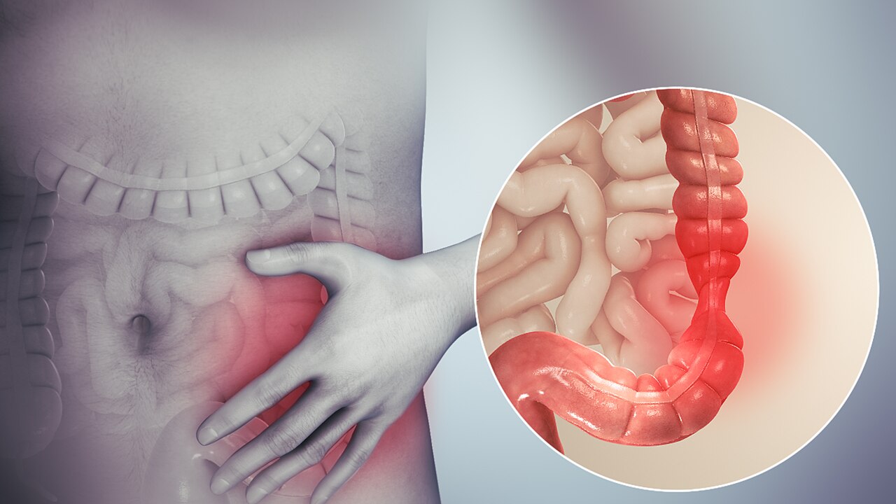 Intestino irritable